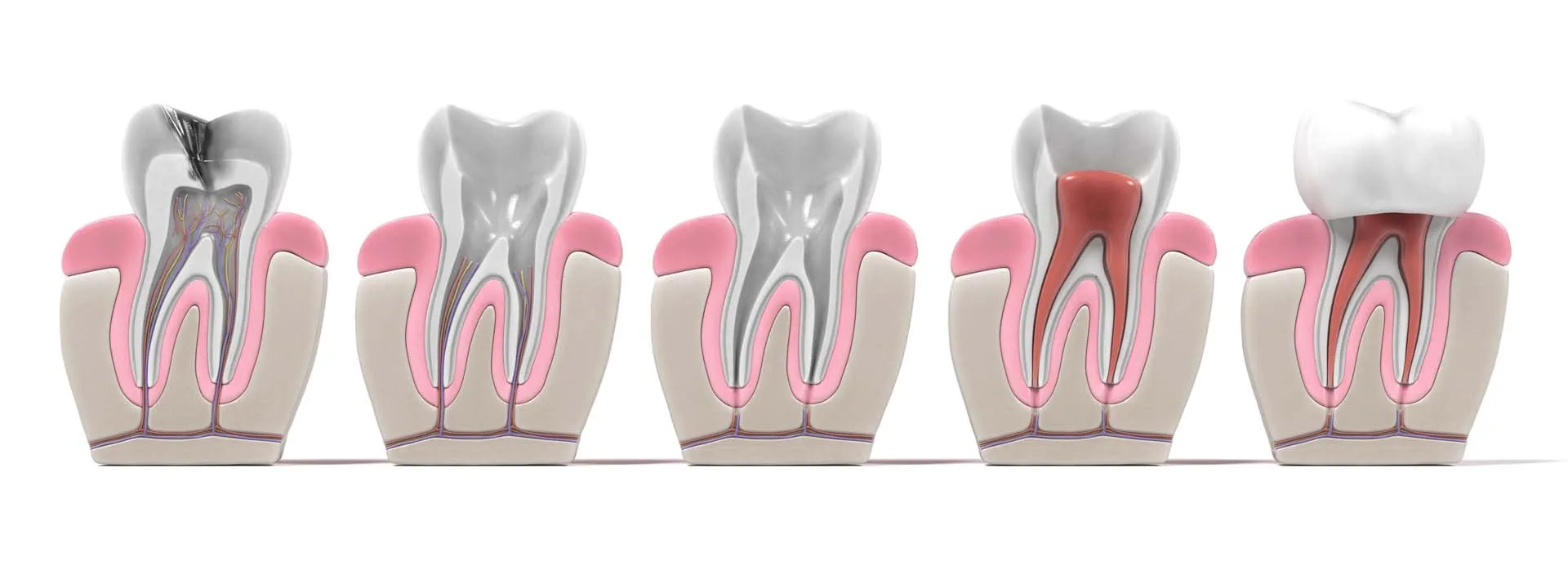 Endodontic retreatment procedure
